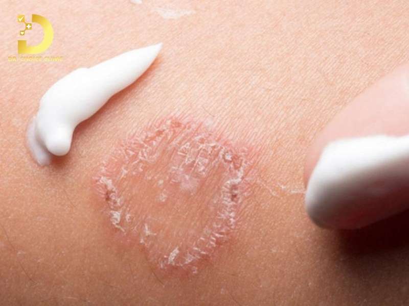 Nấm Thân Mình: Triệu Chứng, Nguyên Nhân & Cách Điều Trị Hiệu Quả 12 Phương pháp điều trị nấm thân mình nào mang lại hiệu quả tối ưu và an toàn?