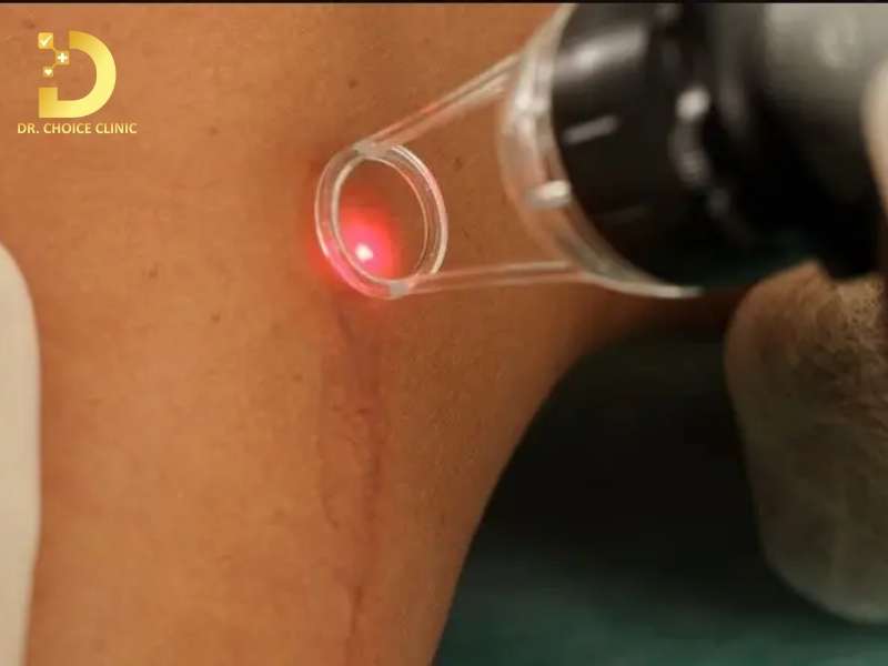 Sẹo Lồi Ở Đầu Gối: Nguyên Nhân & Cách Điều Trị Hiệu Quả 13 Liệu trình điều trị sẹo lồi 4in1 (Điều trị nội khoa nền tảng)
