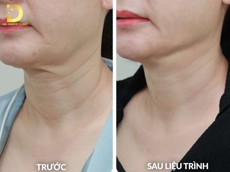 Lão Hóa Da Cổ: Nguyên Nhân, Dấu Hiệu & Cách Khắc Phục 12 Phương pháp nào trẻ hóa da cổ hiệu quả?