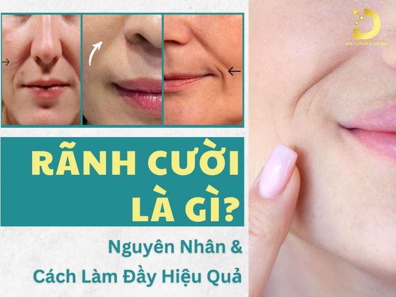 Rãnh Cười Là Gì? Nguyên Nhân & Cách Làm Đầy Hiệu Quả 8 Rãnh cười là gì?