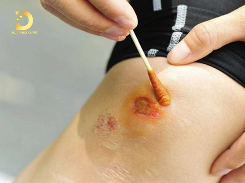 Vết Thương Lên Da Non Bị Thâm: Nguyên Nhân & Cách Chăm Sóc, Điều Trị 12 Sai phổ biến nào khiến vết thâm mãi không thuyên giảm? lầm