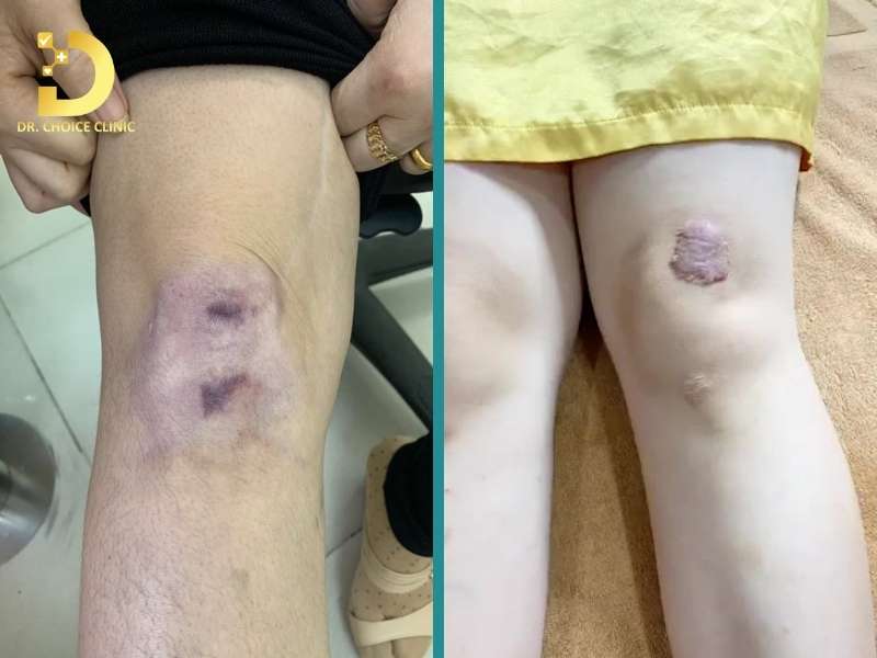 Sẹo Lồi Ở Đầu Gối: Nguyên Nhân & Cách Điều Trị Hiệu Quả 10 Sẹo lồi ở đầu gối là gì?