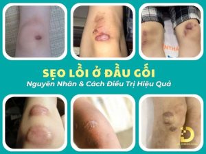 Sẹo lồi ở đầu gối