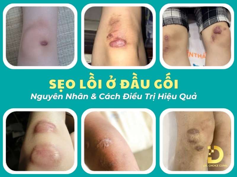 Sẹo Lồi Ở Đầu Gối: Nguyên Nhân & Cách Điều Trị Hiệu Quả 9 Sẹo lồi ở đầu gối