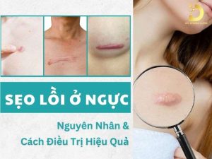 Sẹo lồi ở ngực