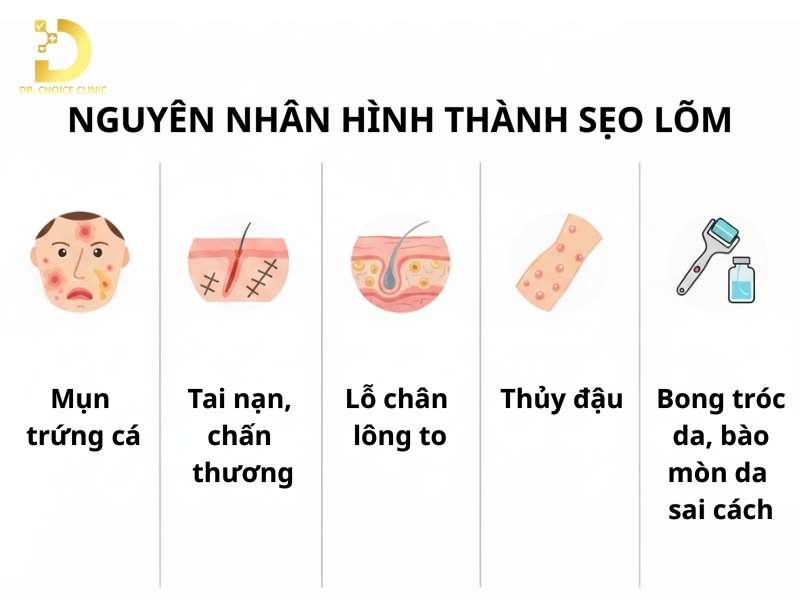 Sẹo Rỗ (Sẹo Lõm): Đặc Điểm, Phân Loại, Nguyên Nhân & Nguyên Tắc Điều Trị 11 Sẹo rỗ hình thành do đâu?