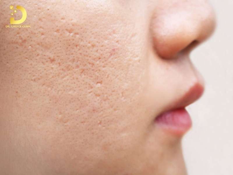 Sẹo Rỗ (Sẹo Lõm): Đặc Điểm, Phân Loại, Nguyên Nhân & Nguyên Tắc Điều Trị 10 Sẹo rỗ (lõm) là gì?