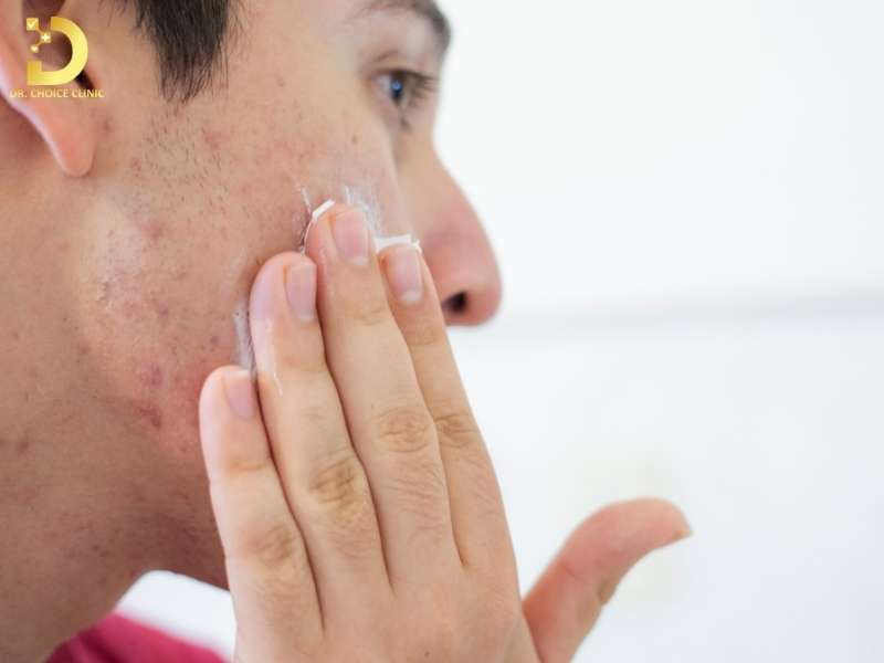 Skincare Cho Da Mụn: Chu Trình Chuẩn & Lưu Ý Sử Dụng Mỹ Phẩm 14 Skincare cho da mụn theo từng tình trạng da