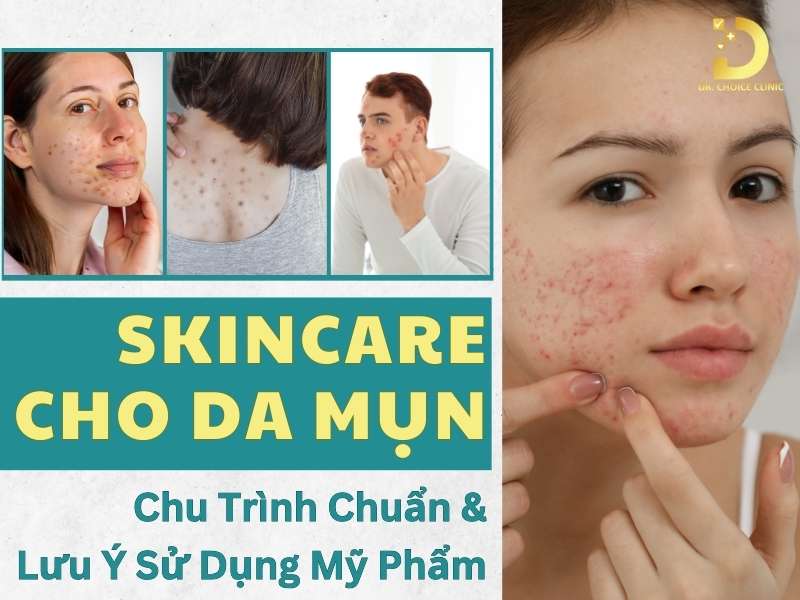 Skincare Cho Da Mụn: Chu Trình Chuẩn & Lưu Ý Sử Dụng Mỹ Phẩm 11 Skincare cho da mụn
