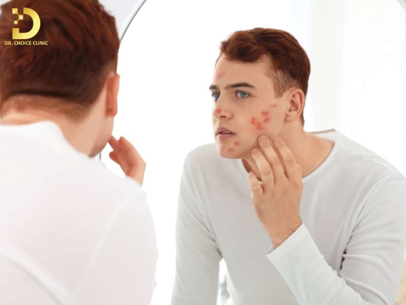 Skincare Cho Da Mụn: Chu Trình Chuẩn & Lưu Ý Sử Dụng Mỹ Phẩm 16 Skincare có thay thế điều trị mụn không?