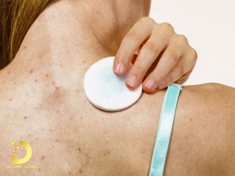 TOP 11 Cách Trị Mụn Lưng Tại Nhà Nhanh, Hiệu Quả 11 Dưỡng ẩm đúng cách để phục hồi hàng rào bảo vệ da