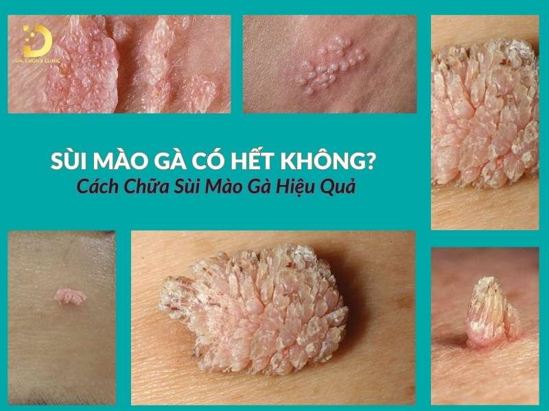 Sùi Mào Gà Có Hết Không? Cách Chữa Sùi Mào Gà Hiệu Quả 9 Sùi mào gà có hết không?