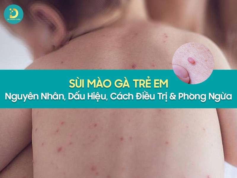Sùi Mào Gà Trẻ Em: Nguyên Nhân, Dấu Hiệu, Cách Điều Trị & Phòng Ngừa 8 Sùi mào gà trẻ em