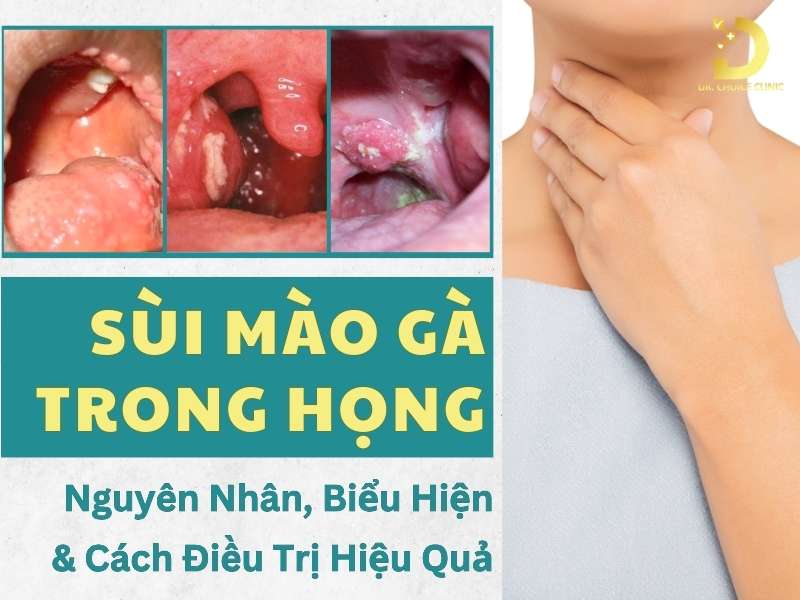 Sùi Mào Gà Trong Họng: Nguyên Nhân, Biểu Hiện & Cách Điều Trị Hiệu Quả 7 Sùi mào gà trong họng