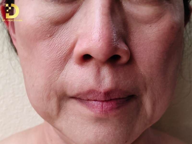 Da Mặt Chảy Xệ: Nguyên Nhân & Cách Nâng Cơ Mặt Hiệu Quả 11 Tại sao da mặt bị chảy xệ?