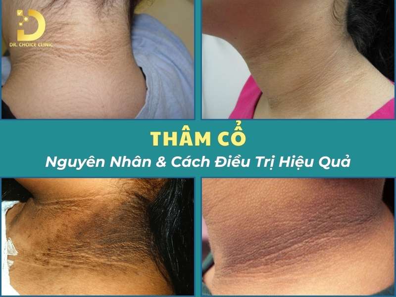 Thâm Cổ: Nguyên Nhân & Cách Điều Trị Nhanh, Hiệu Quả Nhất 8 Thâm cổ