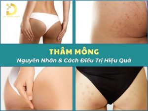 Thâm mông
