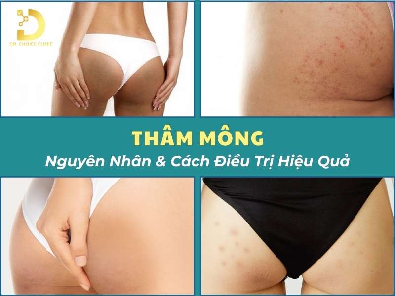 Thâm Mông: Nguyên Nhân & Cách Điều Trị Hiệu Quả 9 Thâm mông