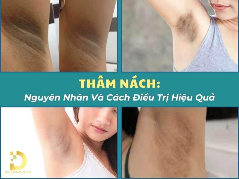 Thâm Nách: Nguyên Nhân Và Cách Điều Trị Hiệu Quả 8 Thâm nách: nguyên nhân và cách điều trị hiệu quả