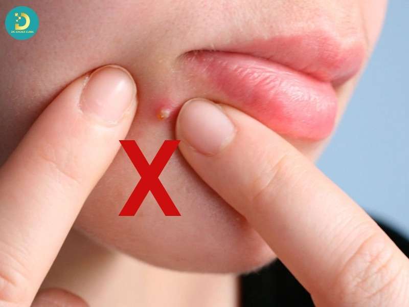 Mụn Mủ Hình Thành Do Đâu? Top Cách Điều Trị Hiệu Quả 21 Thói quen sinh hoạt ảnh hưởng trực tiếp đến mụn mủ