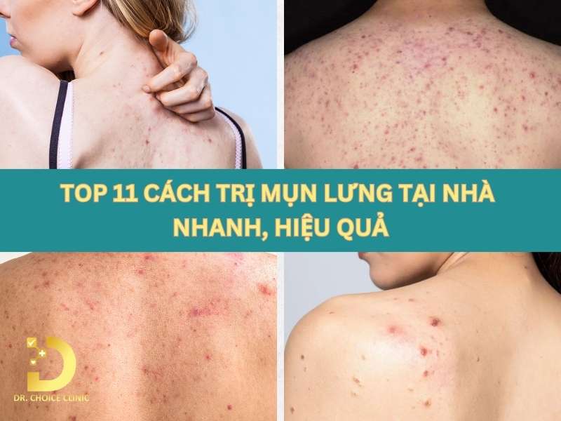 TOP 11 Cách Trị Mụn Lưng Tại Nhà Nhanh, Hiệu Quả 8 Cách trị mụn lưng tại nhà