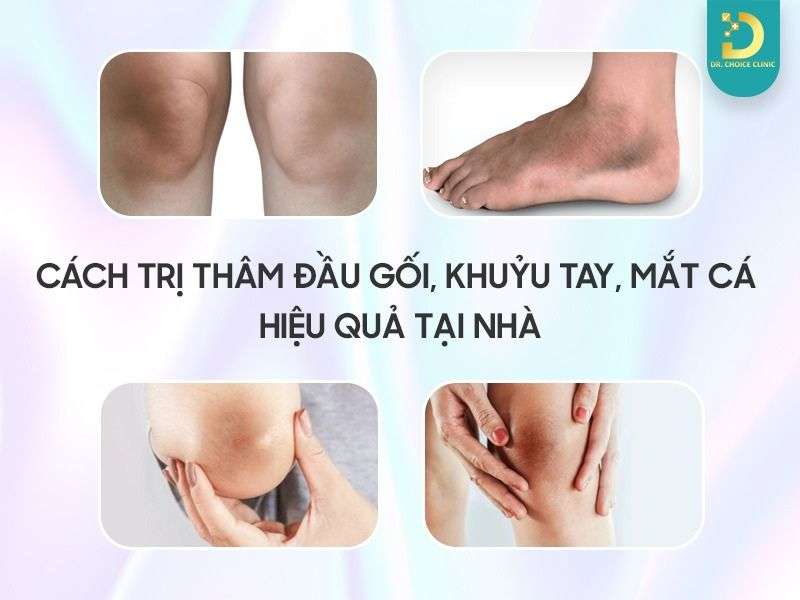 Top Cách Trị Thâm Đầu Gối, Khuỷu Tay, Mắt Cá Hiệu Quả Tại Nhà 12 Top cách trị thâm đầu gối, khuỷu tay, mắt cá
