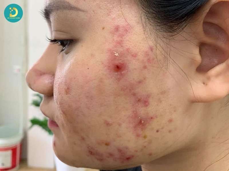 Xông Hơi Trị Mụn: Lợi Ích & Cách Thực Hiện Tại Nhà 16 Trường hợp mụn và làn da không nên xông hơi