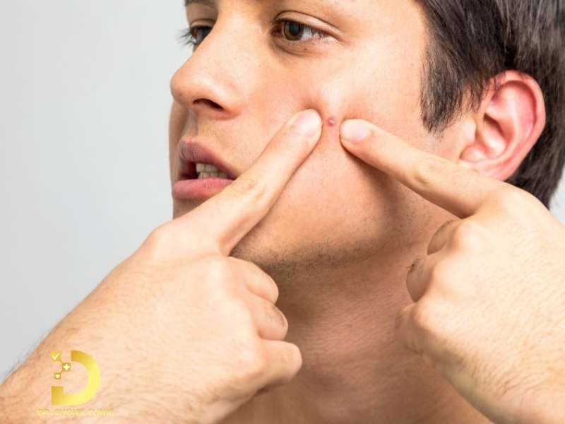 Mụn Bọc Là Gì? Nguyên Nhân, Các Loại Và Cách Điều Trị Hiệu Quả 12 Tự nặn mụn khi còn sưng đỏ (nặn non)