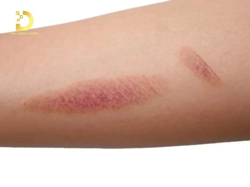 Vết Thương Lên Da Non Bị Thâm: Nguyên Nhân & Cách Chăm Sóc, Điều Trị 10 Vết thương lành nhưng da non bị thâm do đâu?