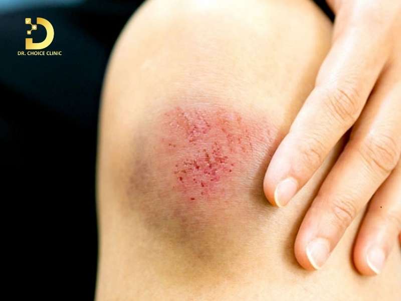 Vết Thương Lên Da Non Bị Thâm: Nguyên Nhân & Cách Chăm Sóc, Điều Trị 9 Vết thương lên da non bị thâm là gì?