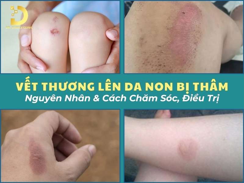 Vết Thương Lên Da Non Bị Thâm: Nguyên Nhân & Cách Chăm Sóc, Điều Trị 8 Vết thương lên da non bị thâm