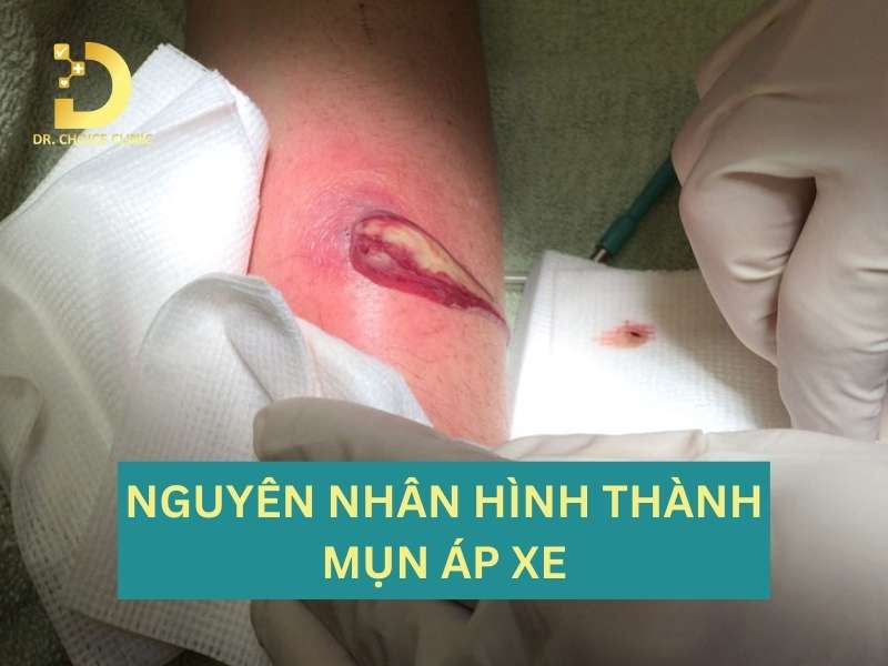 Mụn Áp Xe: Cách Nhận Biết, Nguyên Nhân Và Điều Trị Hiệu Quả 10 Vì sao bị mụn áp xe?