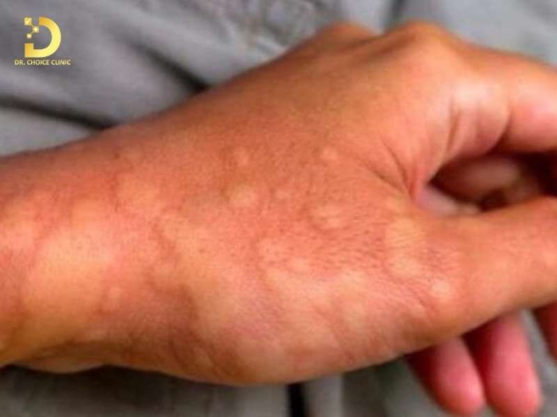 Viêm Da Kích Ứng: Nguyên Nhân, Triệu Chứng, Cách Phòng Ngừa & Điều Trị 11 Làm thế nào phòng ngừa tái phát viêm da kích ứng?