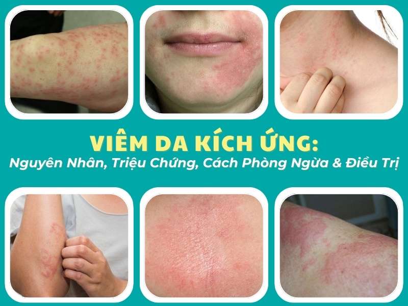 Viêm Da Kích Ứng: Nguyên Nhân, Triệu Chứng, Cách Phòng Ngừa & Điều Trị 8 Viêm da kích ứng