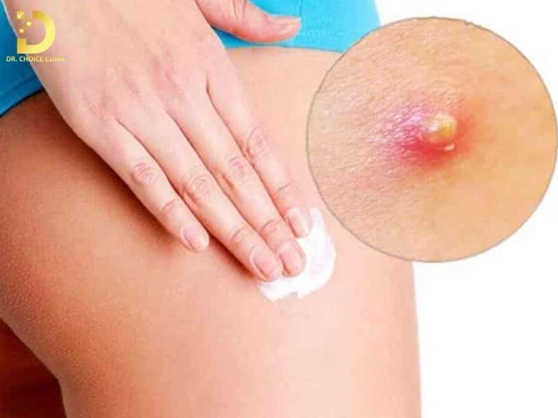 Mụn Ở Mông: Nguyên Nhân & Cách Xử Lý Hiệu Quả Tại Nhà 11 Những điều nên tránh khi tự xử lý mụn mông tại nhà
