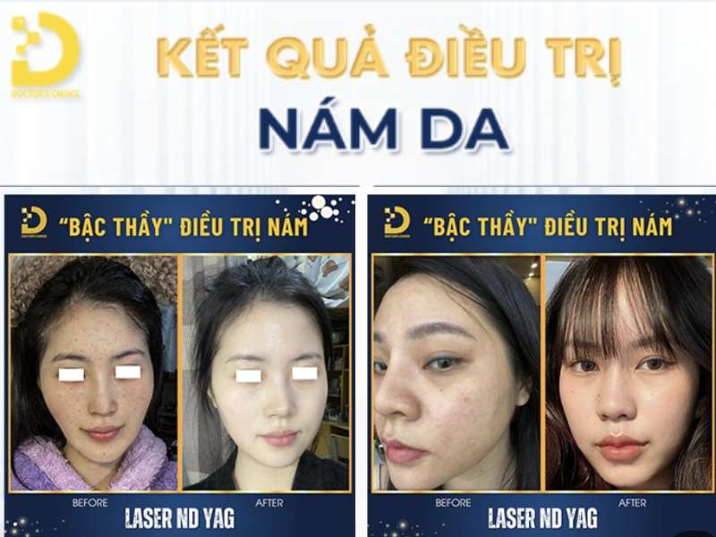 Nám Nội Tiết Là Gì? Nguyên Nhân, Cách Điều Trị & Phòng Ngừa 17 Đơn vị nào cung cấp dịch vụ điều trị nám nội tiết uy tín tại Hồ Chí Minh?
