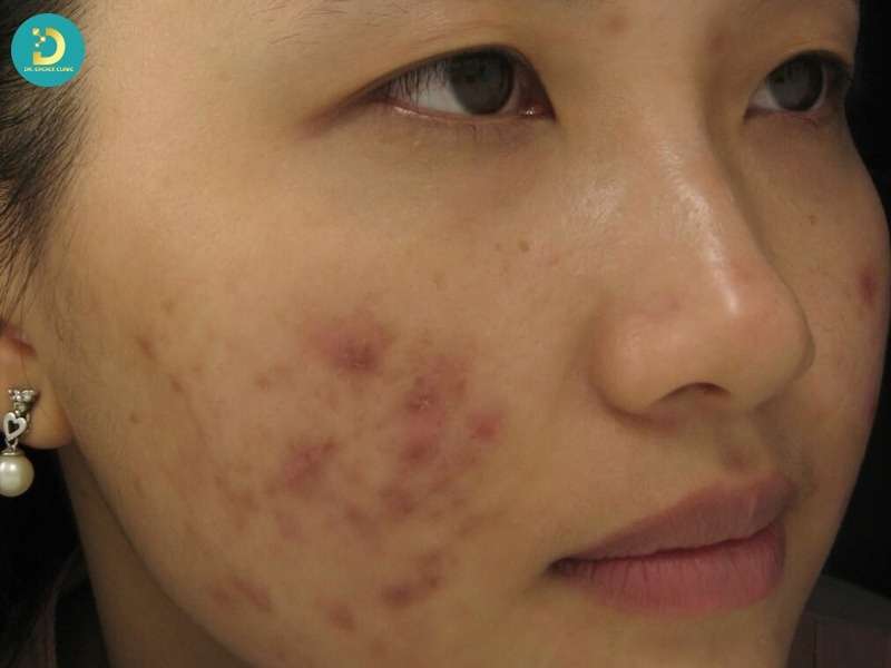 Nặn Mụn Có Tốt Không? Nguyên Tắc & Quy Trình Nặn Mụn Đúng Cách 16 Ảnh hưởng của nặn mụn đến nang lông, trung bì và hàng rào da