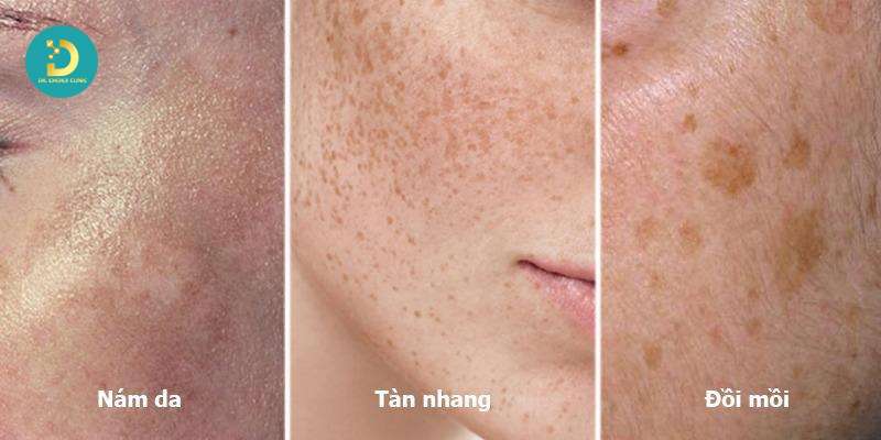 Phân Biệt Nám Da, Tàn Nhang, Đồi Mồi Như Thế Nào? 12 Bảng so sánh nhanh nám da, tàn nhang, đồi mồi