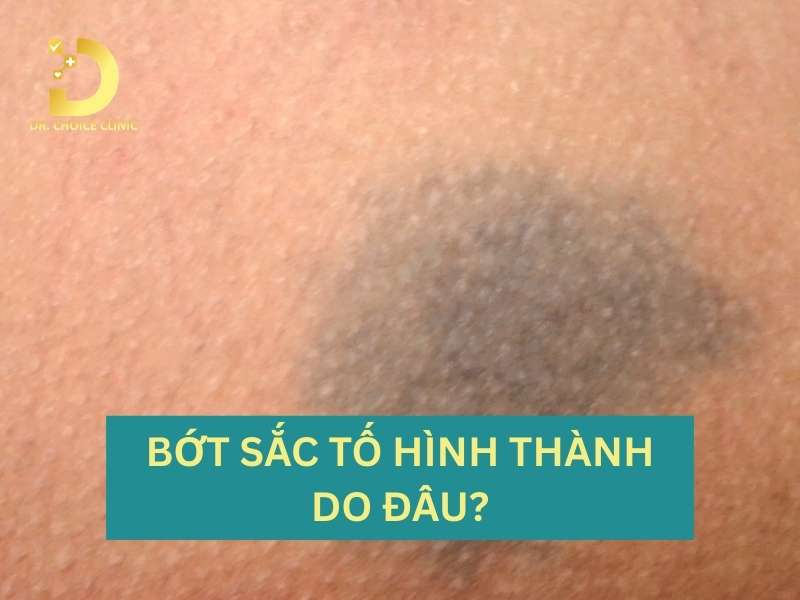 Nhận Biết Các Loại Bớt Sắc Tố & Cách Điều Trị Hiệu Quả 10 Bớt sắc tố hình thành do đâu và khi nào cần thăm khám y khoa?