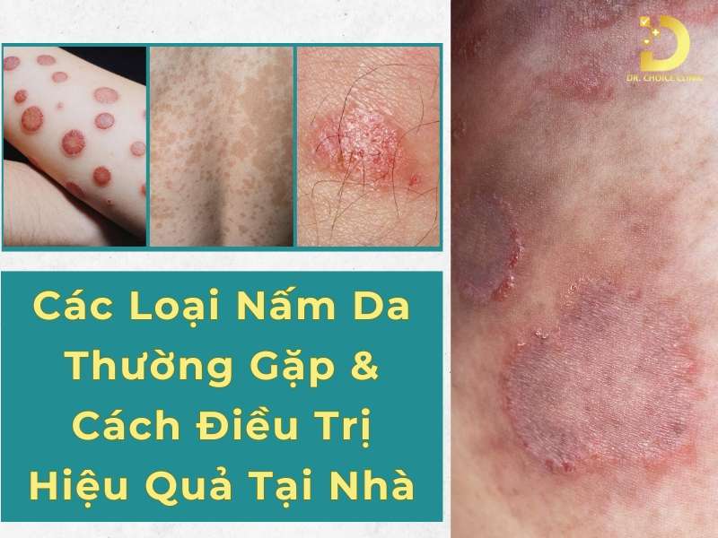 Các Loại Nấm Da Thường Gặp & Cách Điều Trị Hiệu Quả Tại Nhà 13 Các loại nấm da thường gặp