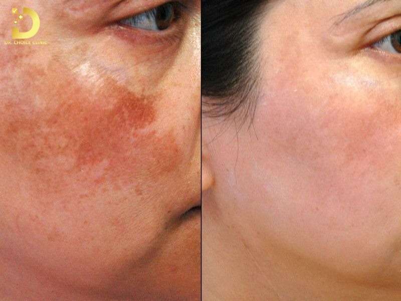 Nám Da: Nguyên Nhân, Phân Loại & Cách Điều Trị 11 Các phương pháp điều trị nám chuyên sâu