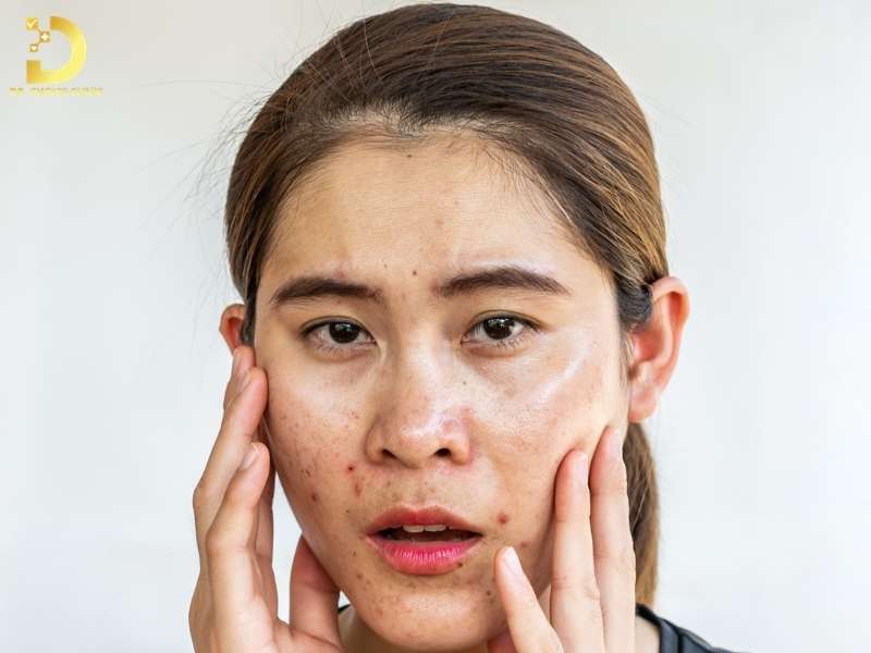 Da Dầu: Nguyên Nhân, Các Vấn Đề Thường Gặp & Cách Khắc Phục Hiệu Quả 10 Các vấn đề thường gặp ở làn da dầu