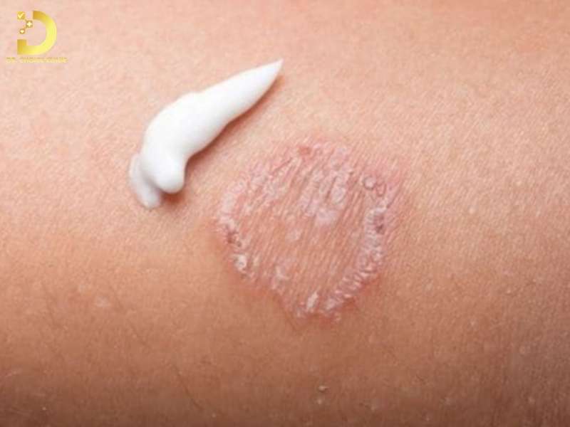 Các Loại Nấm Da Thường Gặp & Cách Điều Trị Hiệu Quả Tại Nhà 20 Cách điều trị nấm da hiệu quả tại nhà