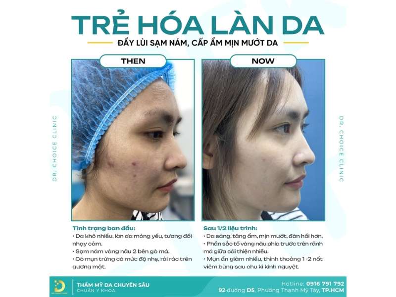 Nám Da: Nguyên Nhân, Phân Loại & Cách Điều Trị 13 Địa chỉ điều trị và trẻ hóa da nám an toàn, uy tín?