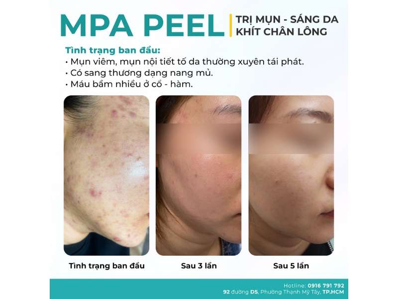 Nặn Mụn Có Tốt Không? Nguyên Tắc & Quy Trình Nặn Mụn Đúng Cách 23 Địa chỉ nào lấy nhân mụn an toàn, chuẩn y khoa tại HCM?
