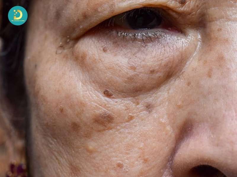 Phân Biệt Nám Da, Tàn Nhang, Đồi Mồi Như Thế Nào? 15 Đồi mồi (Age Spots)