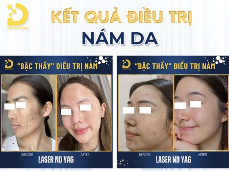 Nám Nội Tiết Là Gì? Nguyên Nhân, Cách Điều Trị & Phòng Ngừa 16 Đơn vị nào cung cấp dịch vụ điều trị nám nội tiết uy tín tại Hồ Chí Minh?