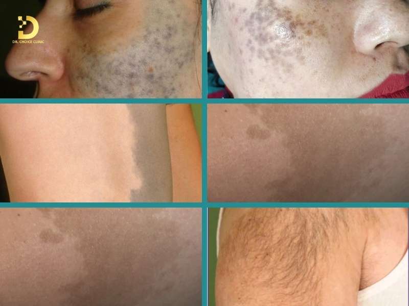 Nhận Biết Các Loại Bớt Sắc Tố & Cách Điều Trị Hiệu Quả 9 Làm thế nào để nhận biết các loại bớt sắc tố thường gặp trên da?