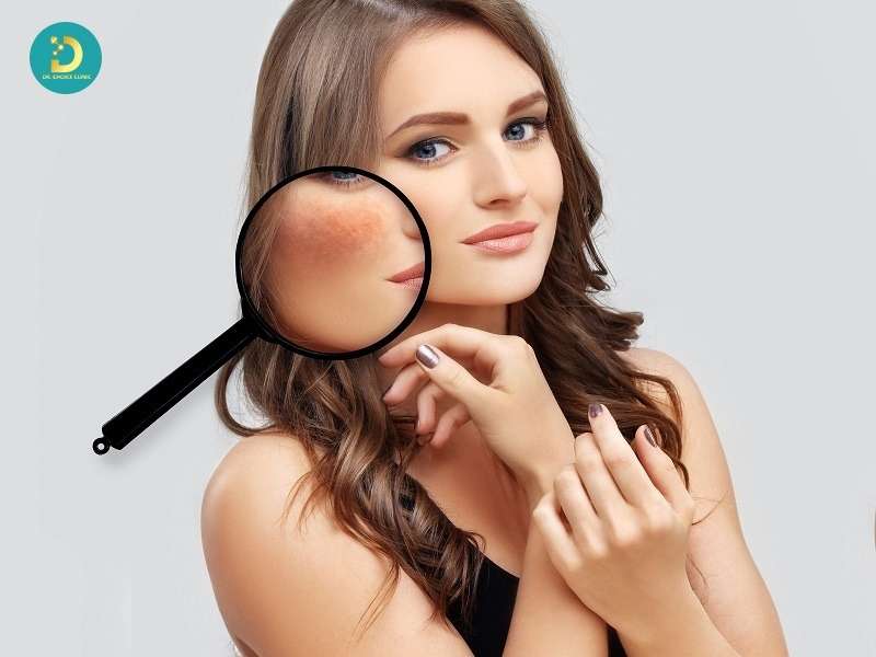 Phân Biệt Nám Da, Tàn Nhang, Đồi Mồi Như Thế Nào? 16 Làm thế nào để nhận biết nám da, tàn nhang, đồi mồi tại nhà?