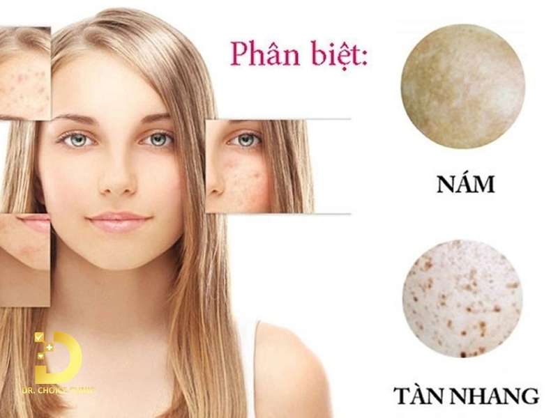 Tàn Nhang: Dấu Hiệu, Nguyên Nhân & Cách Điều Trị Hiệu Quả 14 Làm thế nào để phân biệt tàn nhang với nám da và đồi mồi?